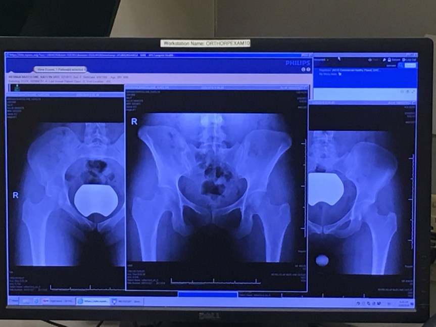 Back on the Injury Train: Pubic Ramus Stress&nbsp;Fracture